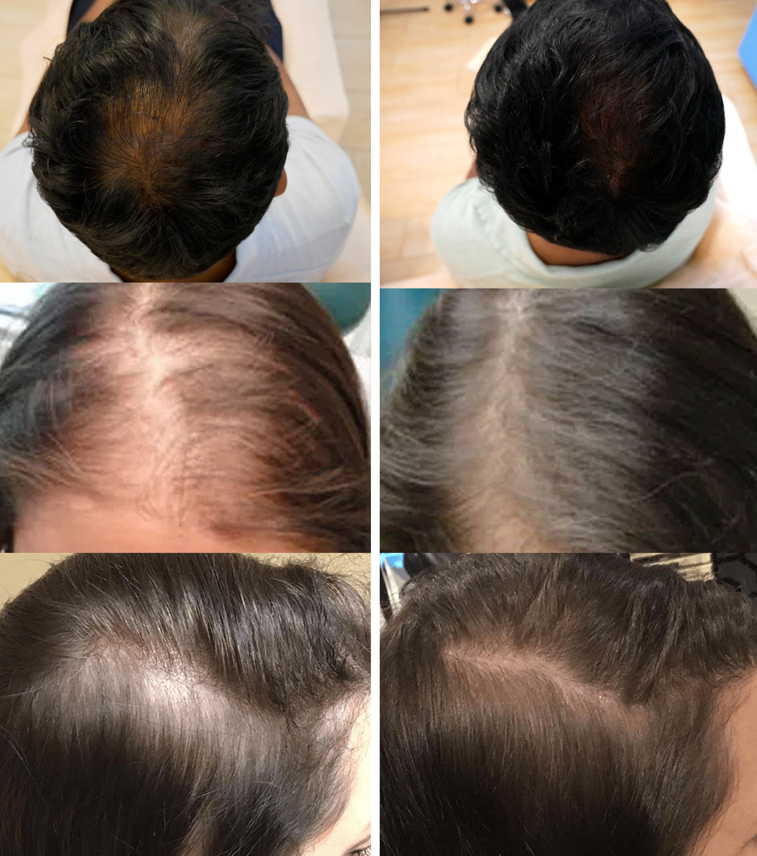 Hair fillers for women | solution for hair loss | Sarasin Clinic