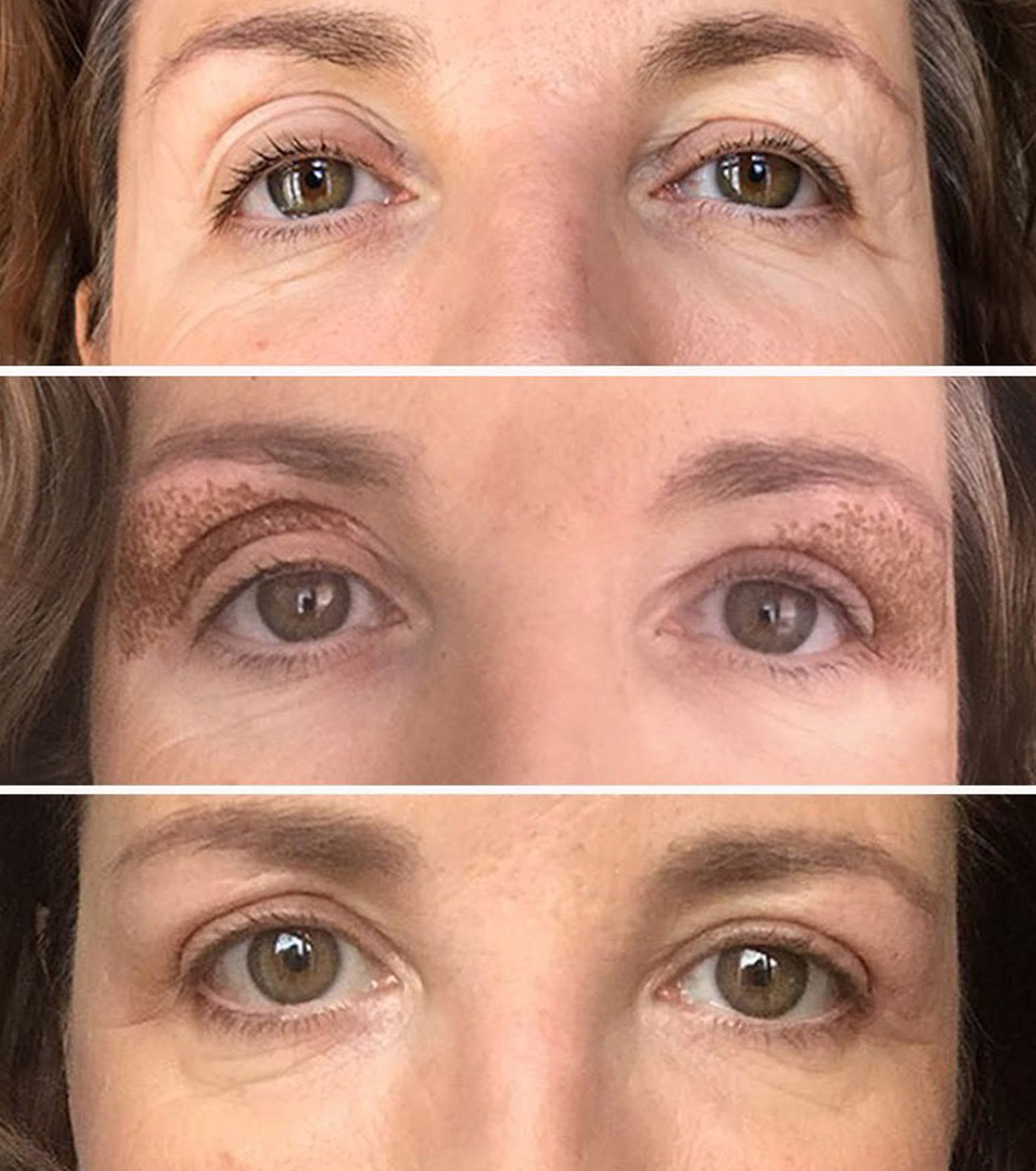 https://eskulap.co.uk/wp-content/uploads/plexr-eyelid-lifting-droopy-correction-skin-eskulap-clinic.jpg